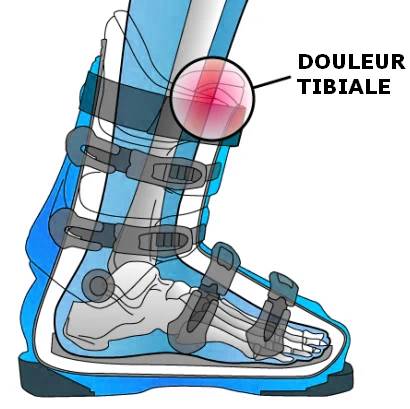 Chaussure de ski : comment éviter les douleurs tibiales ? 